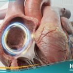 رفرفة أذينية