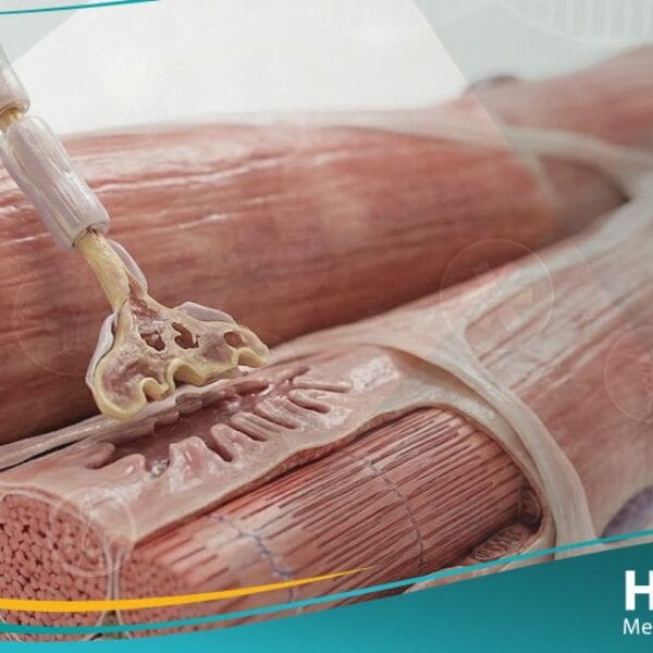 زوال التعصيب العضلي