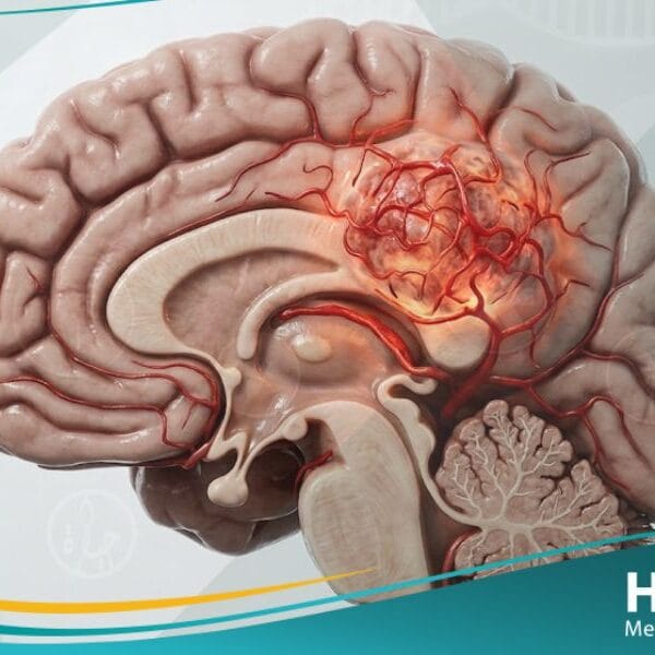 سرطان الدماغ