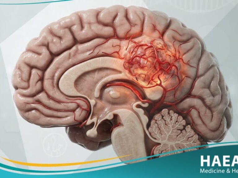 سرطان الدماغ