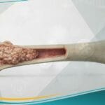 سرطان العظام