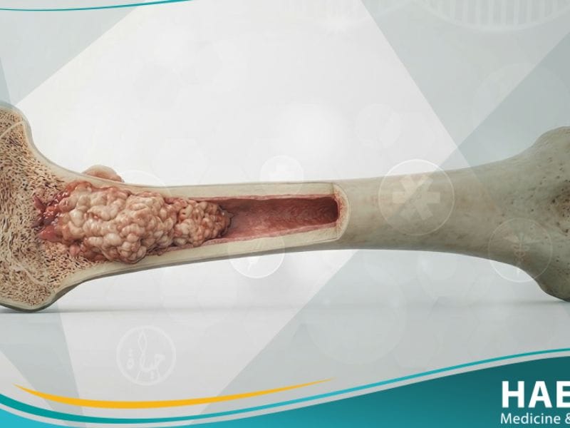 سرطان العظام