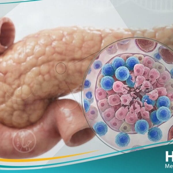 _سكري من النمط 1