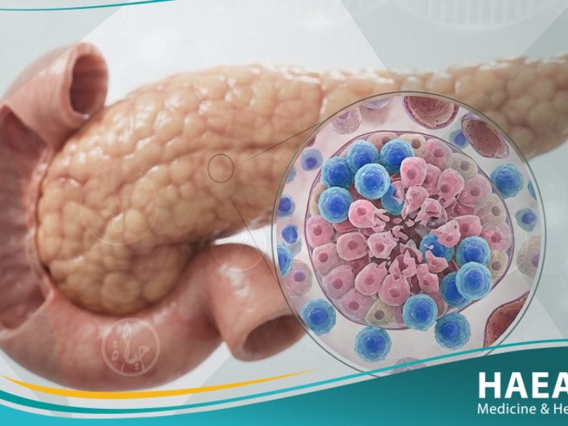 _سكري من النمط 1