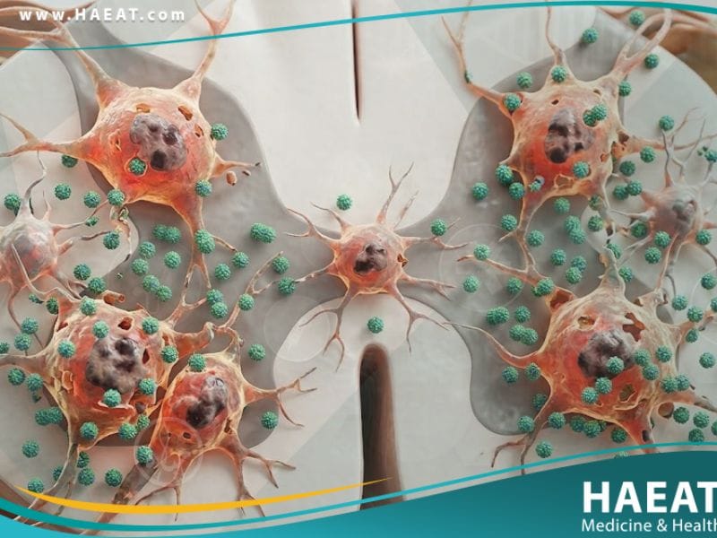 شلل الأطفال