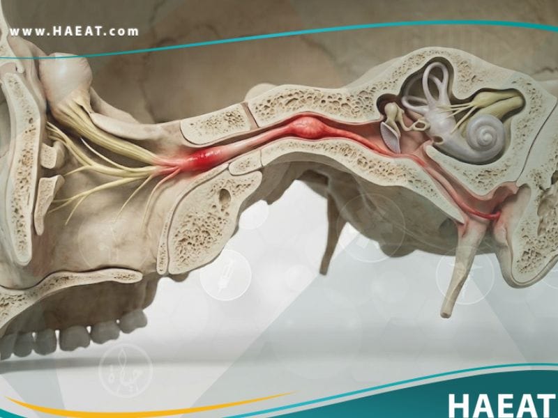 شلل العصب الوجهي