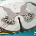 _ضمور النخاع الشوكي