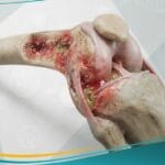 عدوى العظام والمفاصل لدى الأطفال