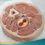 عرج متقطع (1)