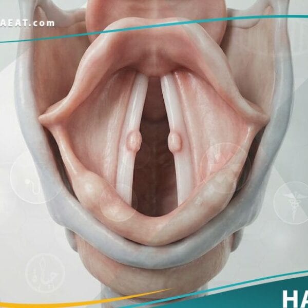 عقيدات وأورام الحنجرة الحميدة