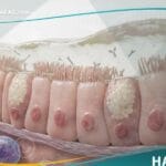 عوز الغلوبولين المناعي أ