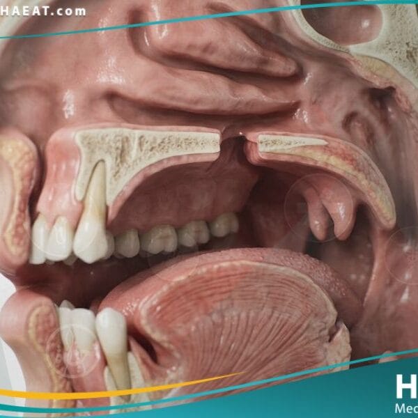 عيوب خلقية لجوف الفم (1)