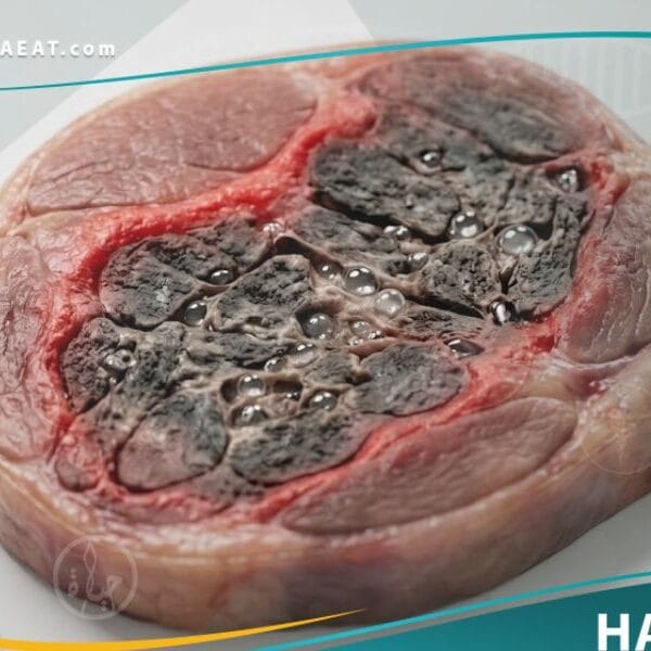 غنغرينا غازية (1)