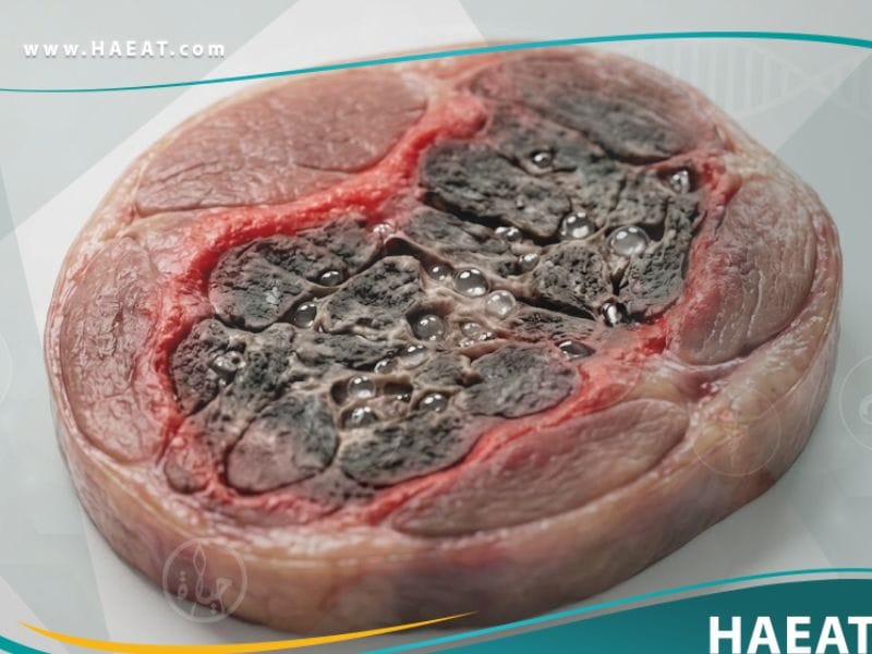 غنغرينا غازية (1)