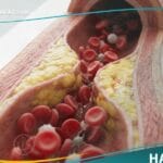 _فرط شحميات الدم