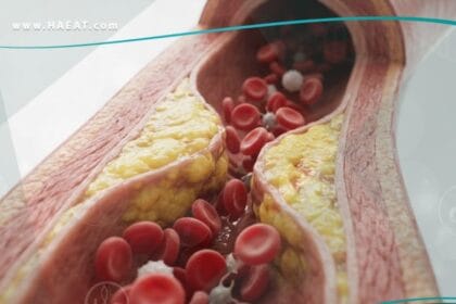 _فرط شحميات الدم