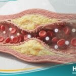 فرط شحميات الدم لدى مرضى السكري