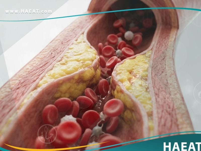 _فرط شحميات الدم