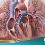 فرط ضغط الدم الرئوي