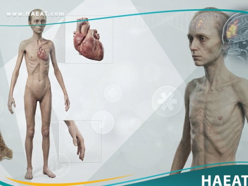 فقد الشهية العصابي