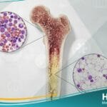 فقر الدم اللاتنسجي