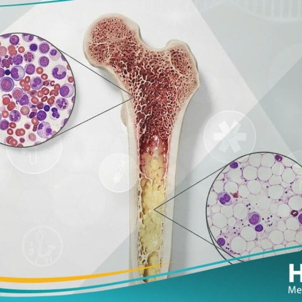 فقر الدم اللاتنسجي