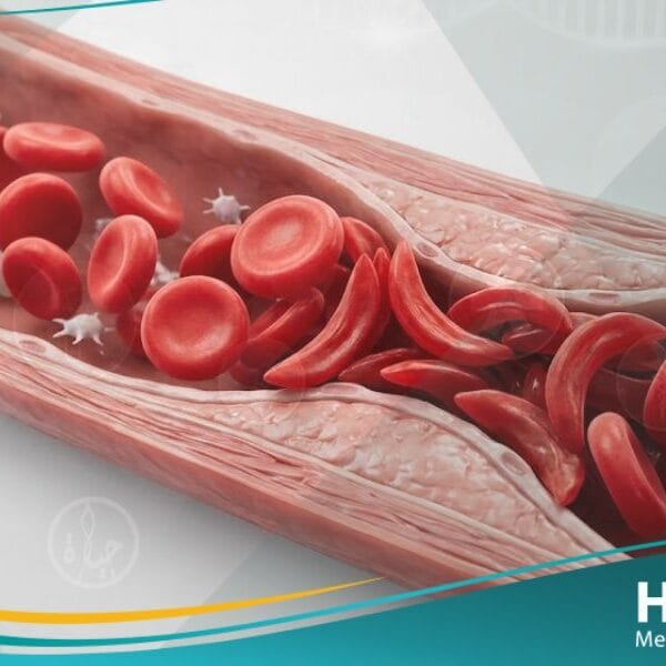 _فقر الدم المنجلي