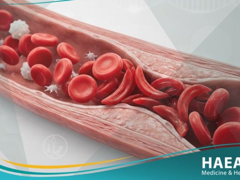 _فقر الدم المنجلي