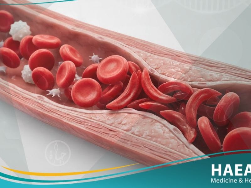 _فقر الدم المنجلي