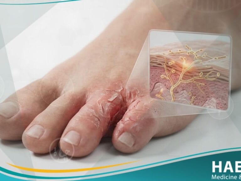 قدم الرياضي