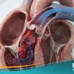 قصور الصمام الرئوي (1)