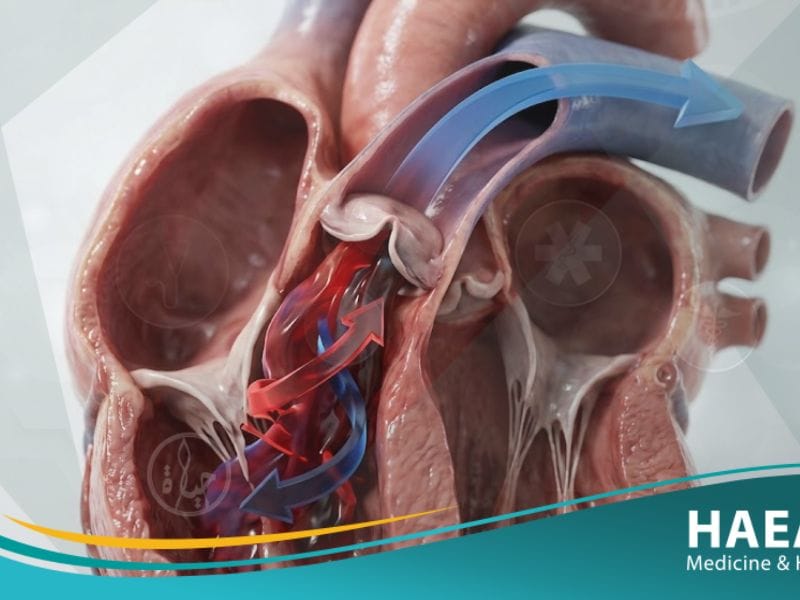 قصور الصمام الرئوي (1)