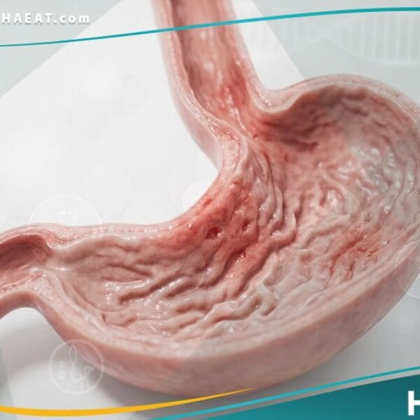 قيء الدم لدى حديثي الولادة