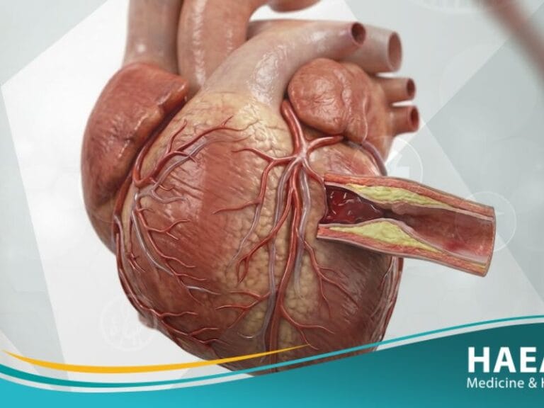 كربة تاجية حادة