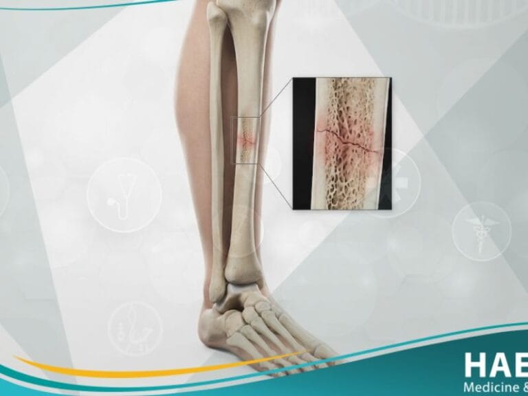 _كسر الإجهاد