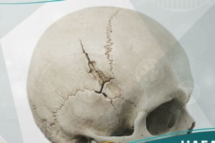 كسر الجمجمة