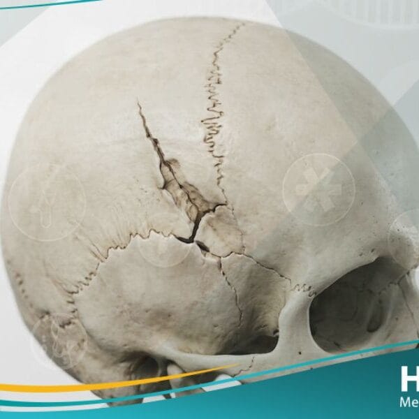 كسر الجمجمة