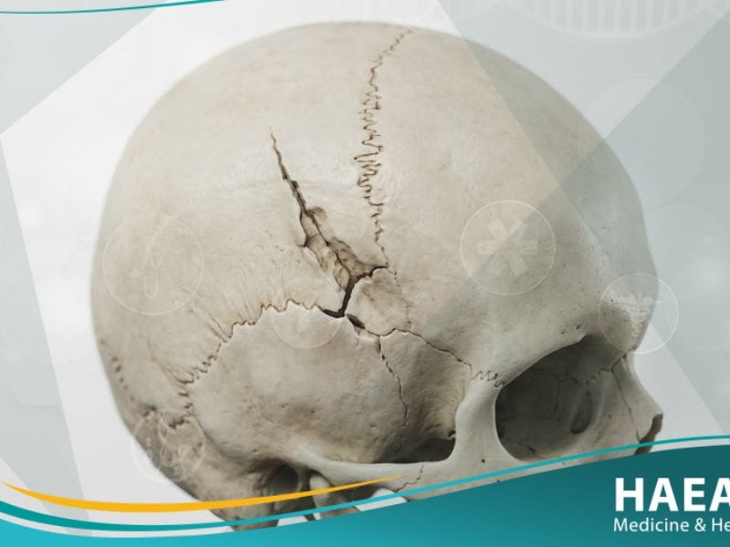 كسر الجمجمة