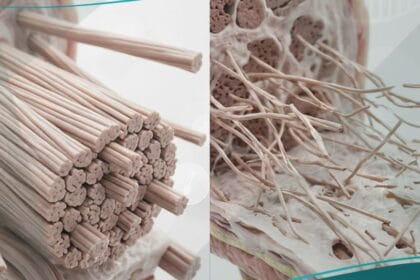 متلازمة إهلر دانلوس (1)