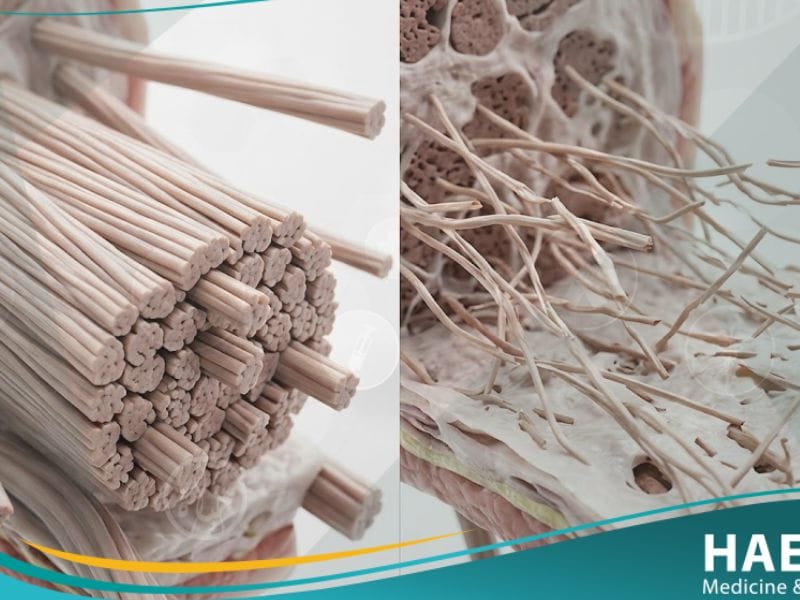 متلازمة إهلر دانلوس (1)