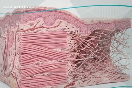 متلازمة إهلر دانلوس