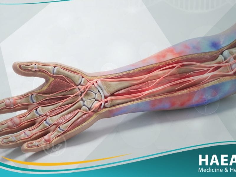 متلازمة الألم الإقليمية المعقدة