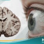 متلازمة الرنح وتوسع الشعيرات