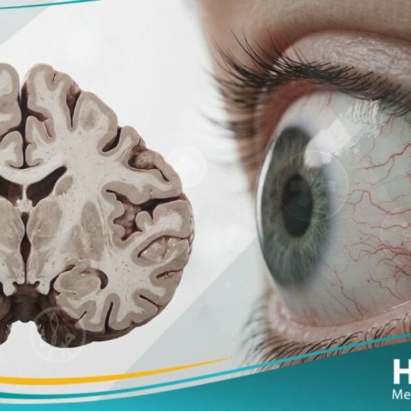 متلازمة الرنح وتوسع الشعيرات