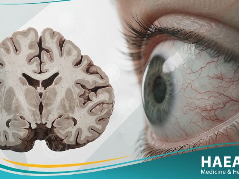 متلازمة الرنح وتوسع الشعيرات