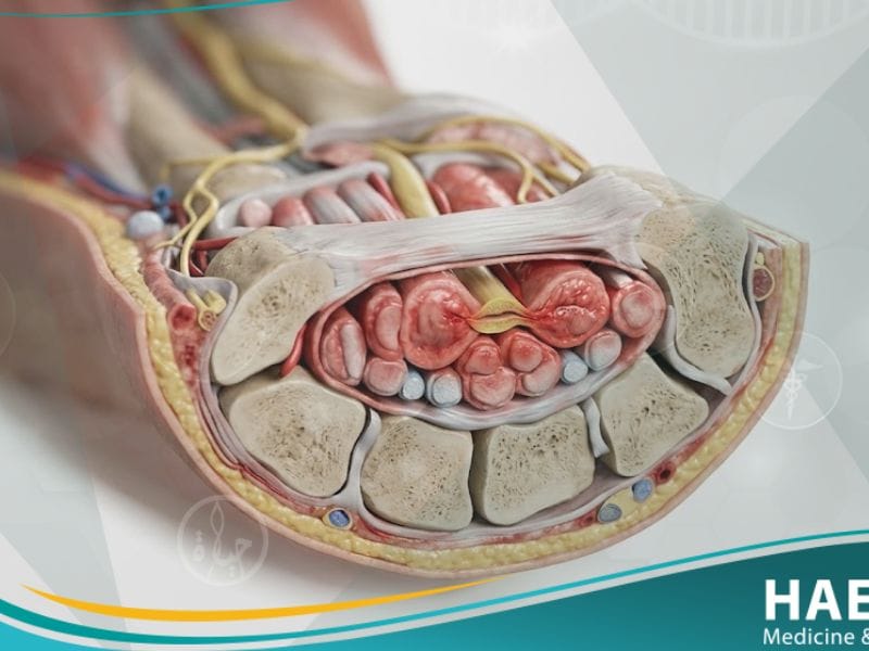 _متلازمة النفق الرسغي (1)