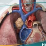 متلازمة الوريد الأجوف العلوي (1)