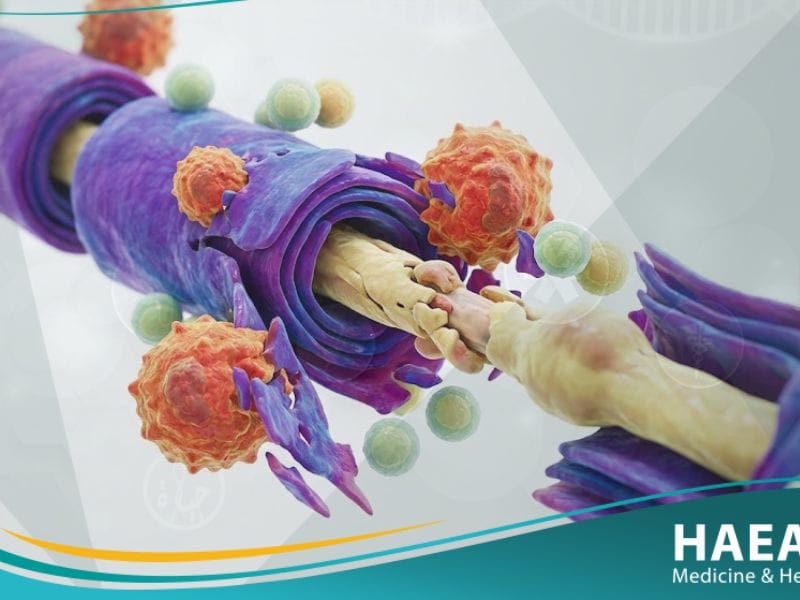 متلازمة جيلن باري