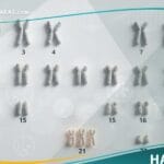 متلازمة داون