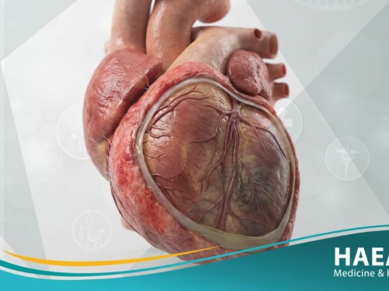 متلازمة دريسلر